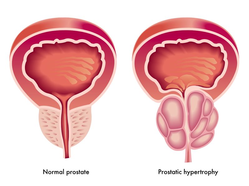 Benign Prostate Hyperplasia